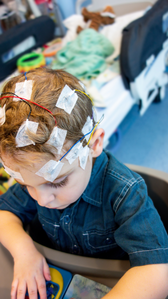 eletrodos de eletroencefalograma (EEG) na cabeça de um bebê para diagnóstico de síndrome de West e detecção de hipsarritmia.