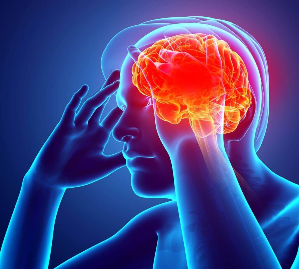 Aneurisma cerebral: o que é, sequelas, sintomas e tratamentos.
