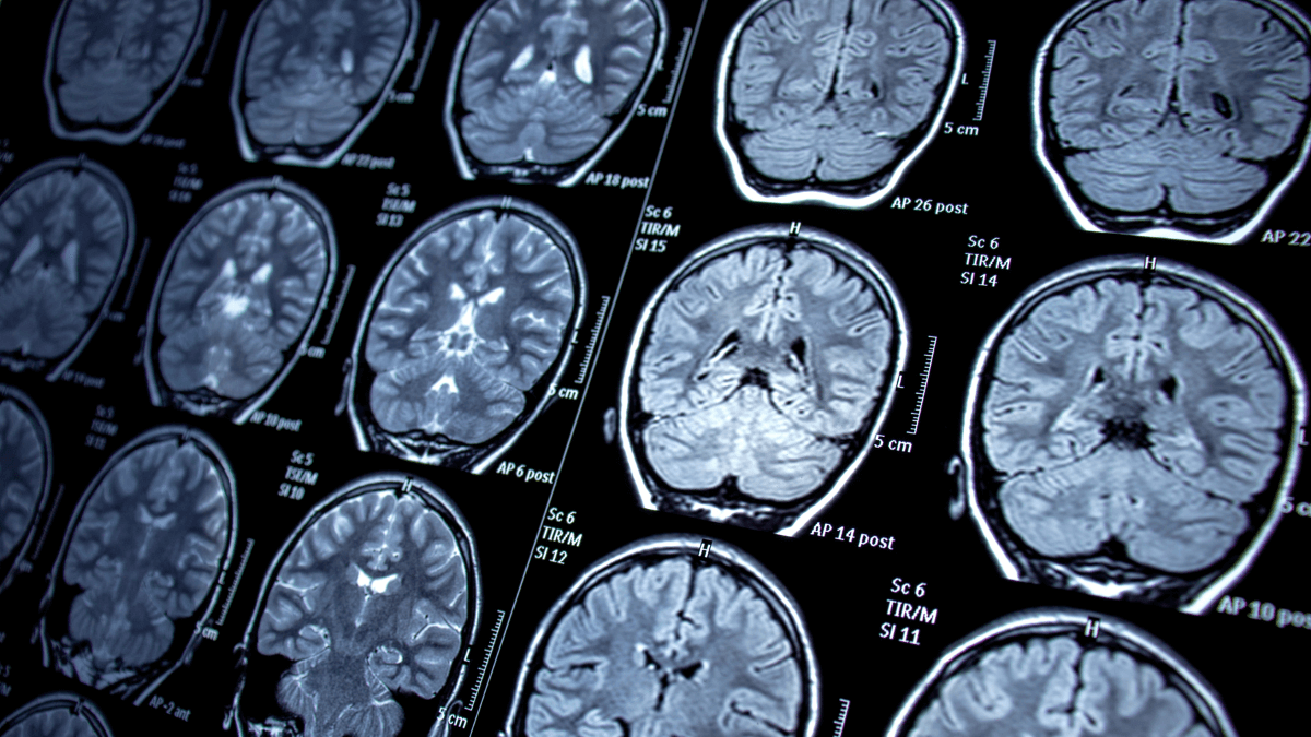 5 doenças neurológicas mais comuns